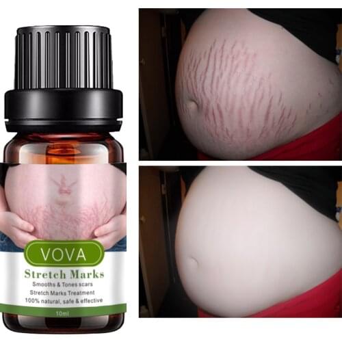 Stretch Marks Remover Essential Oil Skin Care Treatment Cream For Stretch Mark Removal Maternity Slackline For Pregnant Oils