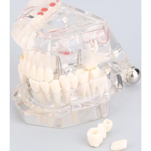 Dental supplies Removable dental restoration model Pathological tooth model Active tooth model Dental implant model