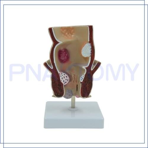 Life Size Rectum Model Human Digestive System Anatomy Tool Medical Sciences Educational Equipments Haemorrhoids Anatomical Model