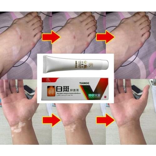 Chinese Medical White Spot Disease Cream Pigment Melanin Promoting Liniment Skin Vitiligo Leukoplakia Disease Treatment 30g