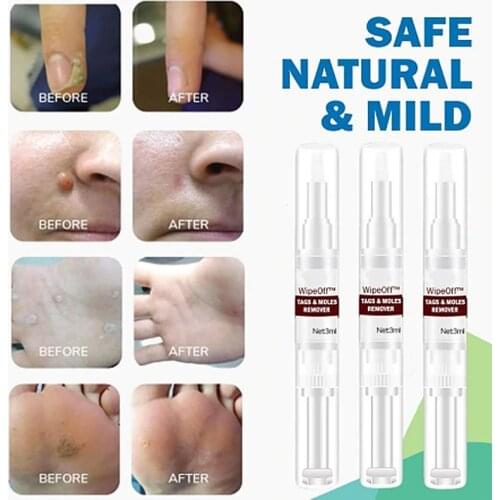 5ml Clear Moles & Tag Wiper Wipeoff Tags & Moles Remover Liquid Wart Removal Pen Genital Wart Treatment