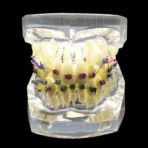 1PC Dental Orthodontic Study Model Transparent Teeth Malocclusion Orthodontic Model With Colorful Brackets&Hot Sale for Teaching