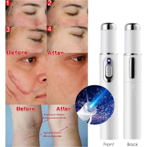 Acne Laser Pen Portable Wrinkle Removal Machine Durable Soft Scar Remover Device Blue Light Therapy Pen Massage Relax