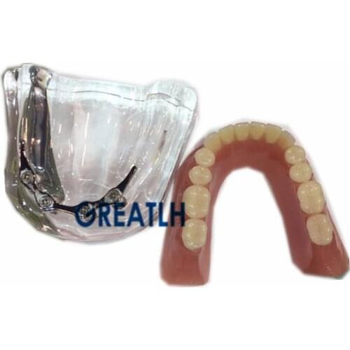 Teeth implant repair model mandibular with Silver bar Denture Teaching study Model Dentist