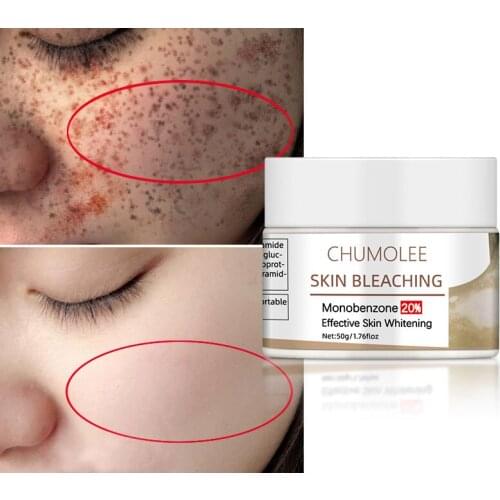 Chumolee Face Whitening Cream Monobenzone Skin Bleaching White Spot Vitiligo Treament Fade Dark Spots Age Spot Bright Face Care
