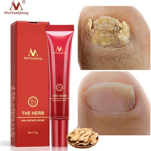 Herbal Effective Nail Fungus Repair Cream Treatment Onychomycosis Paronychia Anti Fungal Infection Toe Nail Fungus Removal Cream