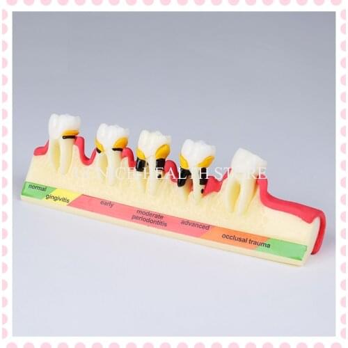 Dental Model Periodontal Disease teeth model M4010 Assort Tooth Typodont Teach Models Dentistry Equipment