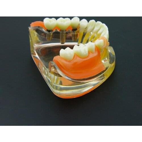 Denture Demo Dental Implant Restoration Teeth Model Removable Bridge #6006