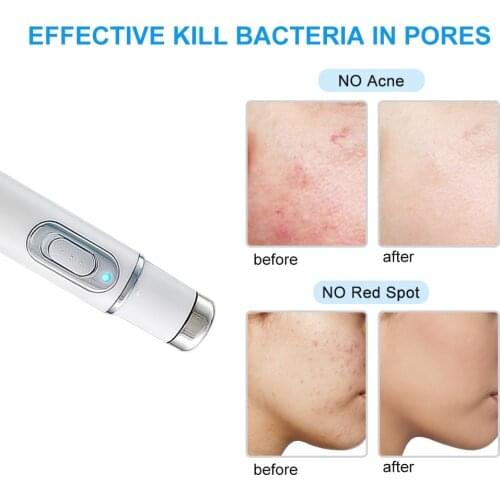Portable Blue Light Acne Laser Pen Therapy Varicose Veins Treatment Laser Pen Soft Scar Wrinkle Removal Treatment Massage Relax
