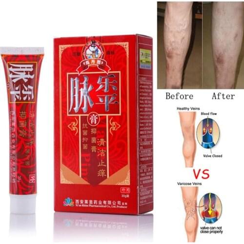 Varicose Veins Treatment Cream Ointment Vasculitis Phlebitis Spider Veins Pain Varicosity Angiitis Remedy Removal Herbal Cream