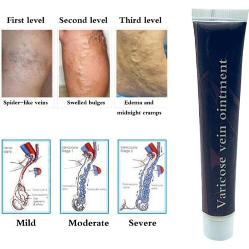 1pc New Chinese Natural Herbal Medicine For Treating Varicose Vascular Inflammation Massage Cream Cure Varicose Vein Ointment