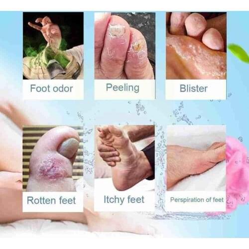Anti Fungal Infections Foot Cream Treatment Athlete Ointment Blisters Relief Foot Erosion Pain Peeling Beriberi Itching Fee F9X9