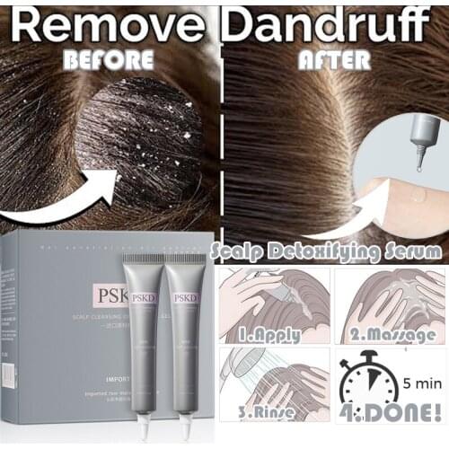 Scalp Detoxifying Serum Andruff Treatment Dandruff Remove Conditioner Fast Get Rid of Dandruff Anti Hair Loss Scalp Cleaning Gel