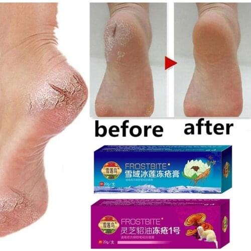 Hand Foot Chapped Peeling Ointment Heel Crack Cream Hand Repair Anti Dry Crack Skin Care Chinese Ointment Treatment Dry Skin