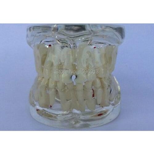 Transparent Milk Teeth Pathology Model, deciduous teeth pathological model