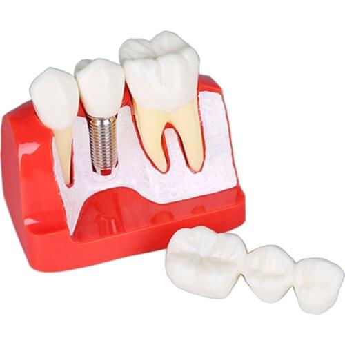 Dental Implant Teeth Model with screw Detachable 4 Times Teeth Model Magnet Implant Analysis Crown Bridge Dental Teaching model
