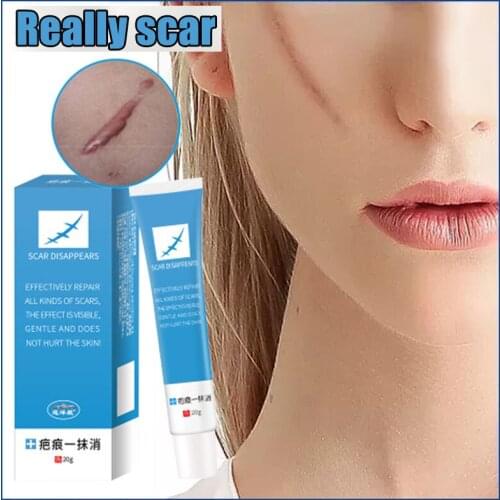 20g Scar Removal Cream Acne Scars Gel Stretch Marks Surgical Scar Burn For Body Pigmentation Corrector Acne Spots Repair Care