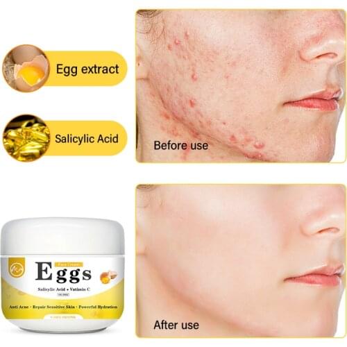 Minch Egg Extract Repair Acne Face Cream Repair Sensitive Skin Vitamin C Cream Anti-acne Shrinks Pore Salicylic Acid Face Cream
