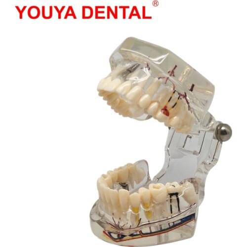 Teeth Neural Repair Dental Implant Pathological Model Dentist Students Communication, Learning, Research Oral Disease Teaching