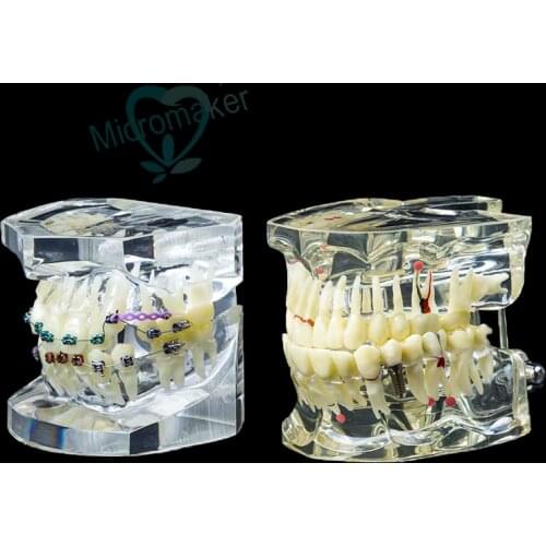 1Pc Dental Orthodontic Study Teach Teeth Model with Metal Brackets Brace Dental Teeth Teaching Model Hiah Quality