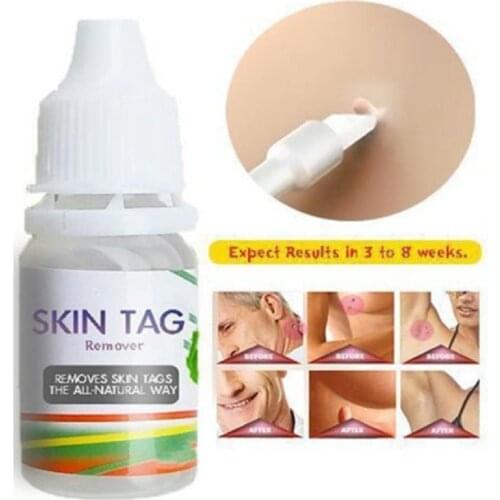 10ml Skin Tag Remover kill Medical Remover Foot Corn Skin Tag Mole & Genital Wart Skin Tag Remover