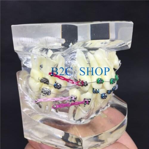 Colorful Brackets Study Model Transparent Teeth With Dental Orthodontic Malocclusion Orthodontic Model
