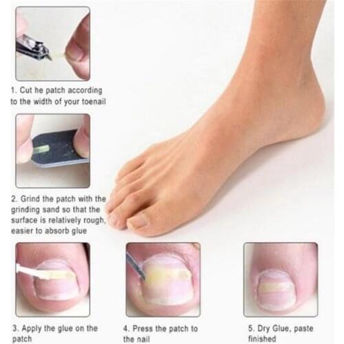 Ingrown Toe Nail Straightening Clip Brace Foot Care Toe Nail Correction Tool