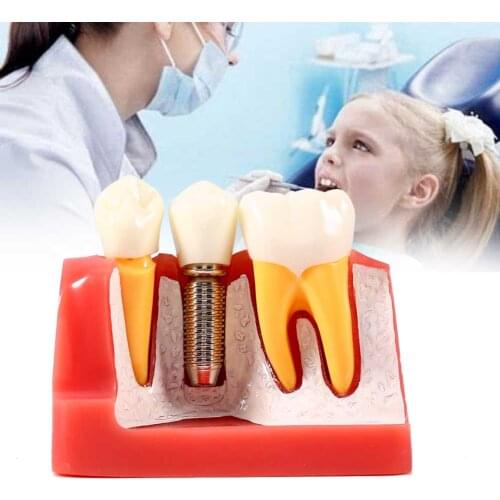 1pc Resin Dental Demonstration Tooth Model Implant Analysis Crown Bridge for Dentist
