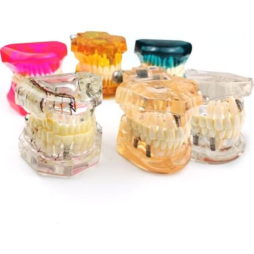 Dental Disease Teaching Study Dental Supplies Dental Implant Disease Teeth Model with Restoration Bridge Tooth Dentist
