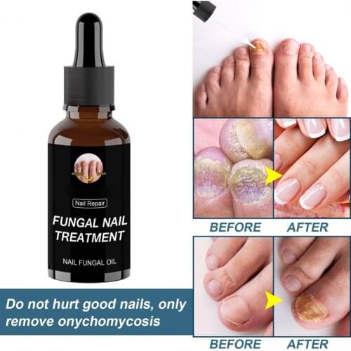 10ml/20ml/30ml/50ml Nail Fungal Oil Anti Infection Moisturizing Synthetic Gentle Nail Repair Essence for Onychomycosis