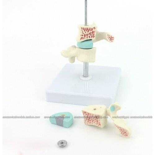 CMAM/12391-1 Osteoporosis, Medical Backbone Anatomical Human Model