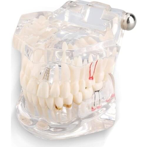 Transparent Adult Pathologies Dental Dentist Implant Demonstration Periodontal Disease Assort Teeth Gums Tooth Care Teaching Stu