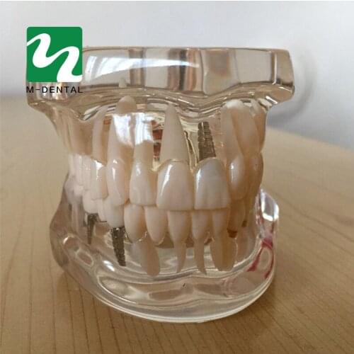 Dental Study Tooth Transparent Adult Pathological Teeth Model Fit for Adult Teaching Study