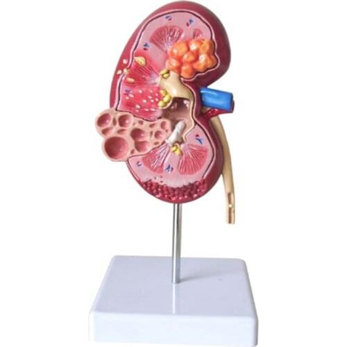 Lesion Kidney Model Human Anatomy Organ Medical Teaching Supplies