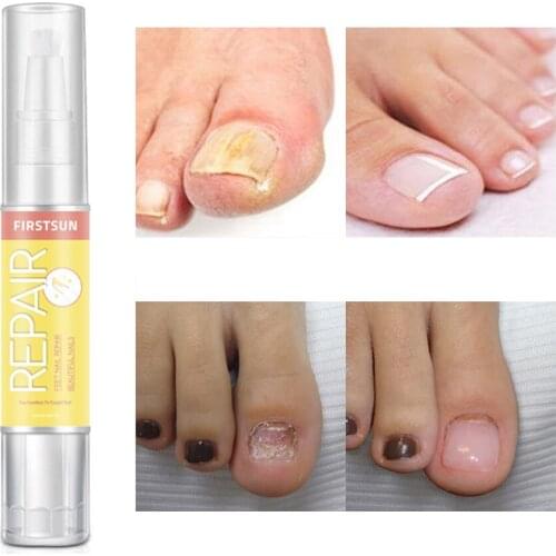 High Quality Fungal Nail Treatment Essence Liquid Whitening Toe Nail Fungus Removal Nail Art Tool Foot Nail/Feet Care Makeup