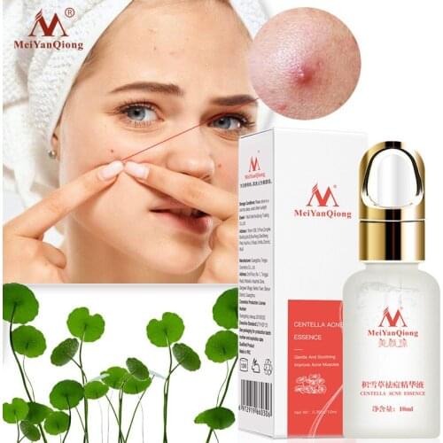 10ml Acne Treatment Face Serum Centella Asiatica Oil Control Shrink Pores Scar Essence Whitening Moisturizer Skin Care