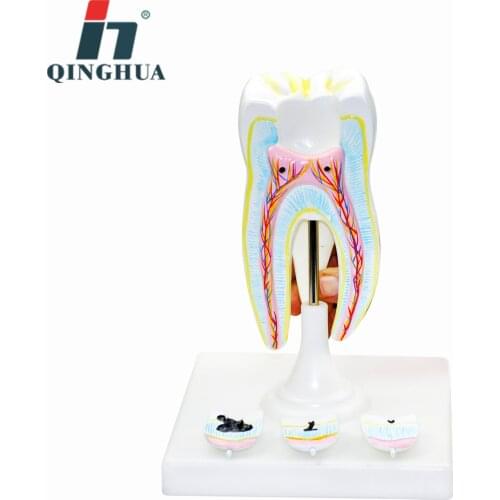 Molar Tooth with Tooth Decay Models Human Lifelike Dental Anatomy Models Biomedical Demonstration Aids Medical Model Supplier