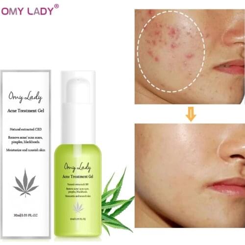 OMY LADY Acne Treatment Gel CBD Pimple Acne Scar Removal Skin Repair Moisturizing Whitening Aloe Soothing Face Skin Care