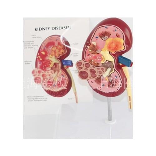 Kidney disease model urology kidney nephron renal glomerulus kidney anatomical model