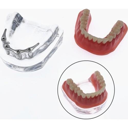 Repair teeth model with implant with Silver Bar Denture Teeth mandibular model Dental Teaching Model