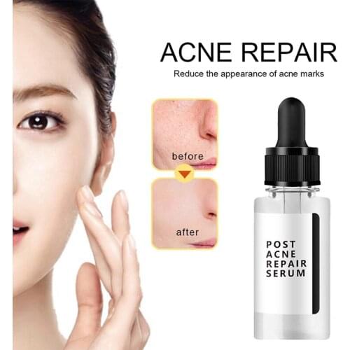 Acne Treatment Essence Moisturizing Lotion Spot Pimple Remover Replenish And Soothe Dry Skin 15/30ml Acne Treatment Essence
