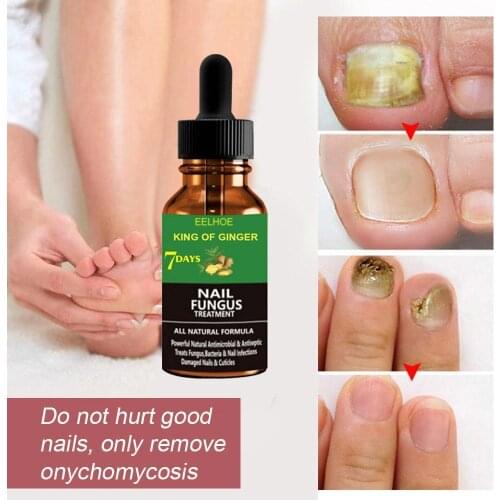 50ml Ginger Foot Antifungal Nail Essence Nails Care Repair Nail Fungal Treatment Anti-Fungus Onychomycosis Removal Liquid
