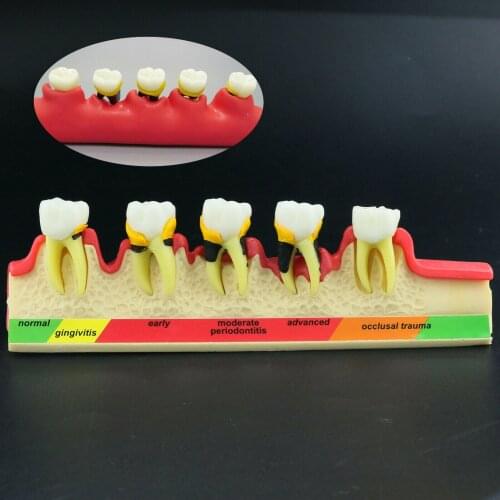 Dental Periodontal Disease assort Periodontics Tooth Disease Model (PER) 4010