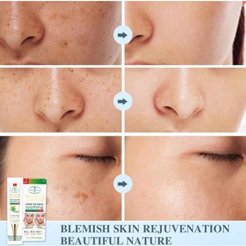 30g Effective Whitening Freckle Cream Remove Melasma Spot Dark Melanin Whitening Pigment Care Skin Cream Moisturizing Acne V7F6