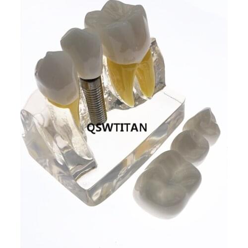 Clear Dental Demonstration Study Teeth Model for Implant Analysis Crown Bridge Model