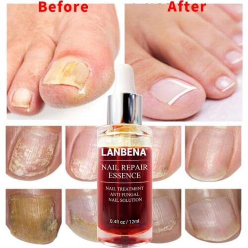 Ho tsale Fungal Nail Repair Essence Serum Toe Nail Fungus Treatment Nails Gel Anti Infection Paronychia Onychomycosis Nails Care