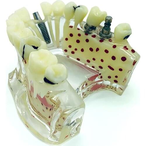 Dental Model Teeth Model Dentistry Products Implant Model Teaching Model