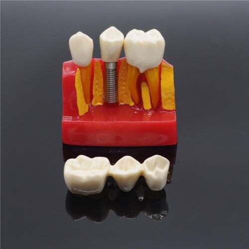 Dentistry Clinic Implant Analysis Crown Bridge Demonstration Teeth Model