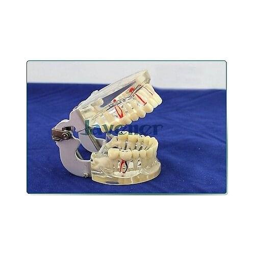 Dental Disease Tooth Teaching Model Pathology Periodontal Diseases Dental Caries