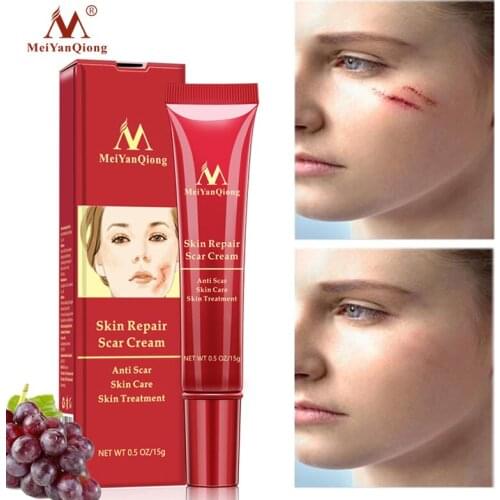 MeiYanQiong Acne Scar Removal Cream Acne Spots Pigmentation Corrector Whiten Cream Anti Scar Stretch Marks Repair Skin Care 15g